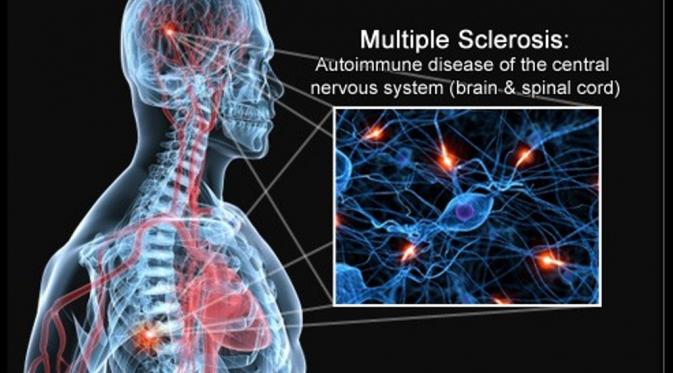 Multiple Sclerosis (Via: anthroposophic-health.org)
