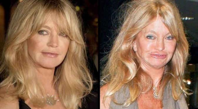 Goldie Hawn (Via: afterplasticsurgery.com)