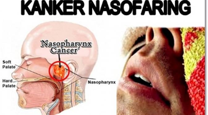 Kanker Nasofaring