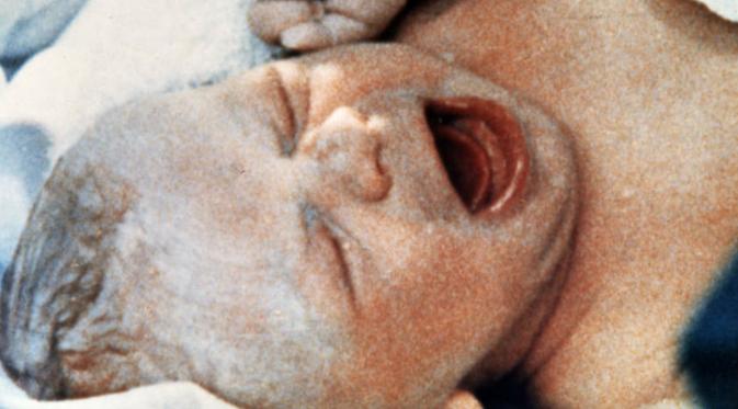 Bayi tabung pertama di dunia lahir. Dinamai Louise Joy Brown. (Tucson.com)
