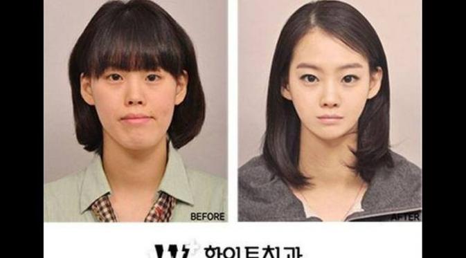 15 Foto Perubahan Wajah Orang Korea Setelah Operasi Pelastik | via: kaskus.co.id