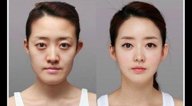 15 Foto Perubahan Wajah Orang Korea Setelah Operasi Pelastik | via: kaskus.co.id