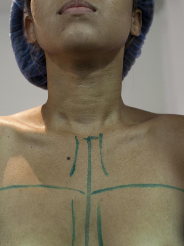 Hati-hati Terhadap Bekas Operasi Implan Payudara | via: thenypost.files.wordpress.com