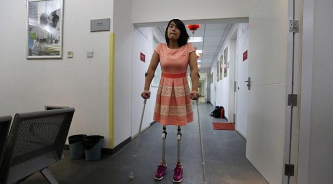 Qian Hongyan berdiri menggunakan kaki prostetiknya (Reuters)